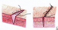 Subcuticular stitch. The skin surface remains inta