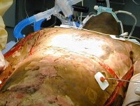 Escharotomy+pictures