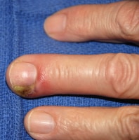 the nail bed. In this case, the paronychia was due to infection after a