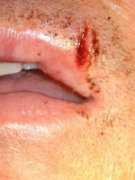 Lip Trauma