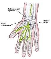 Carpal Tunnel Steroid Injection