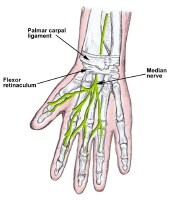 Carpal Tunnel Steroid Injection