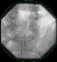 Caudal Epidural With Catheter