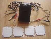 TENS (Transcutaneous Electrical Nerve Stimulator).