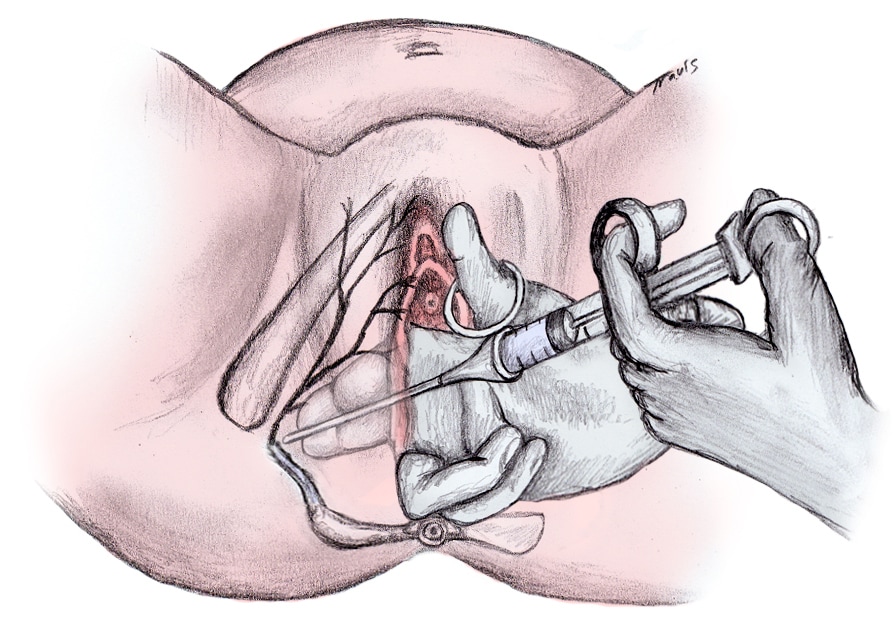 Pudendal block, transvaginal approach.