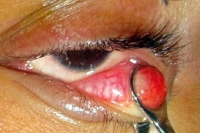 Lower Eyelid Chalazion