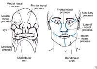 Maxillary process grows medially and overrides th...