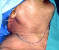 Mcfee Incision