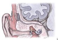 auditory brainstem implant