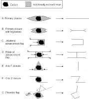 Forehead Reconstruction