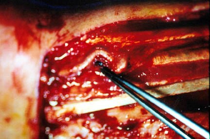 Harvesting the radial forearm flap in the subfascial plane is relatively Harvesting the radial forearm flap in the subfascial plane is relatively