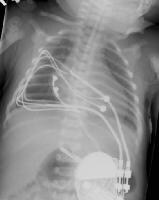 icd devices single and dual chamber defibrillators pacemakers single ...
