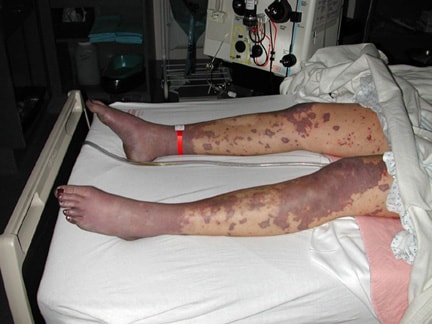 of severe meningococcal infection and is called purpura fulminans. of severe meningococcal infection and is called purpura fulminans.