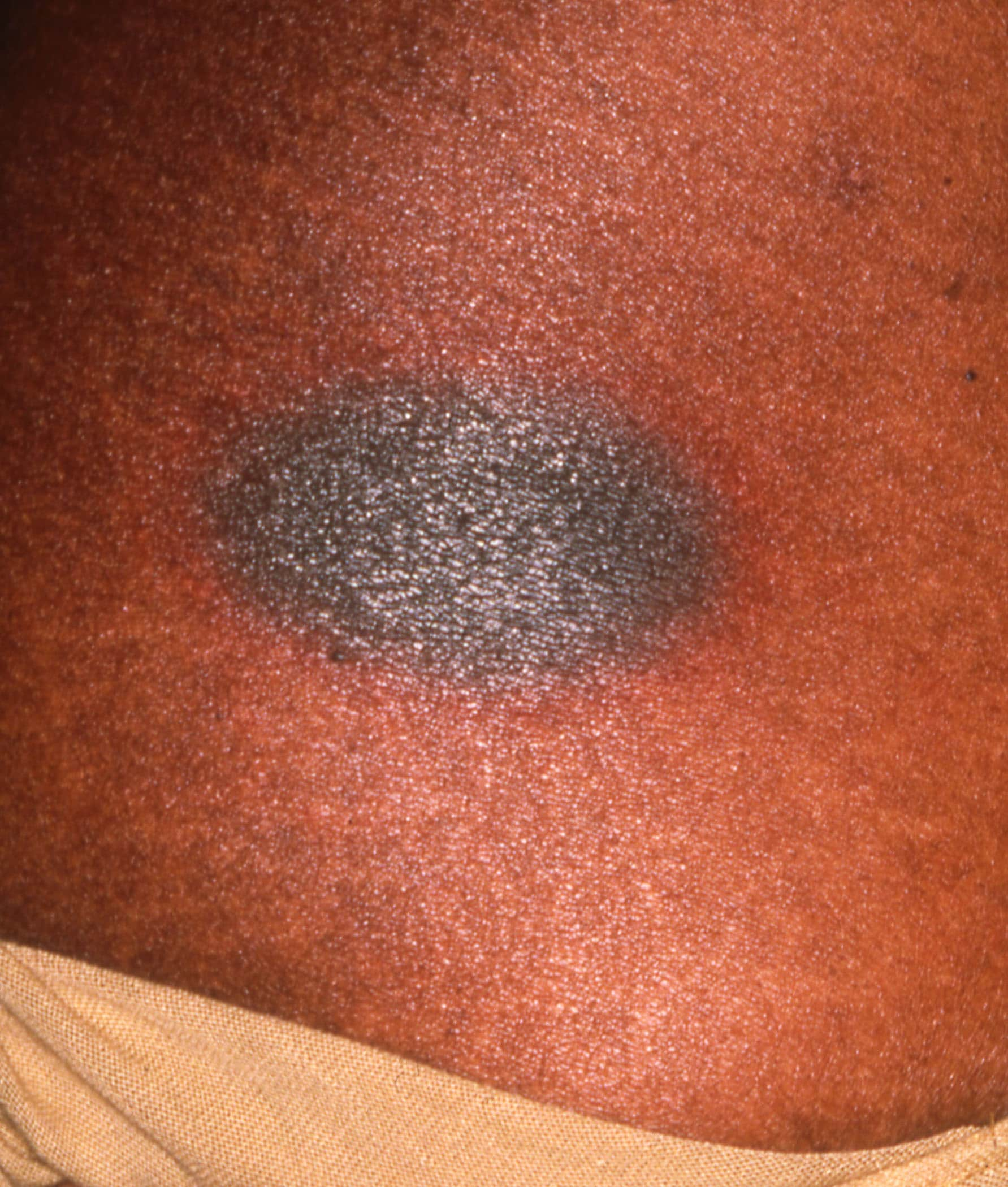 drug-eruptions-dermatitis-medicamentosa-dermatitis-adverse-drug-reaction