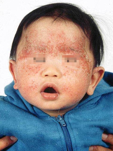 Typical atopic dermatitis on the face of an infan.