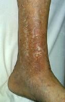 Chronic stasis dermatitis with allergic contact de