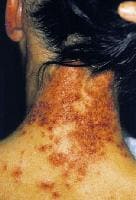 Erythema multiformelike reaction that developed ac