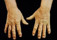 Chronic irritant contact dermatitis of the hands i