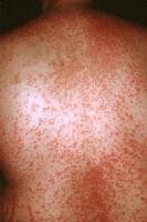 Sulfa Drug Rash