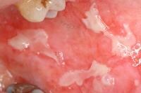 Oral ulcerations in a patient receiving cytotoxic 