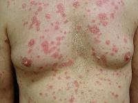 Subacute Cutaneous Lupus