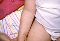 Papular urticaria. 