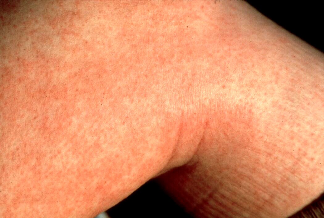 sepsis-rash-images