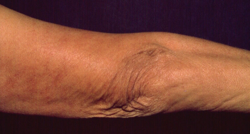 The atrophic skin lesions and fibrotic nodules of.