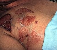 Staphylococcal Scalded