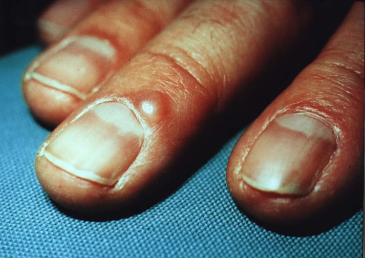 Digital mucous cyst at proximal nail fold. Digital mucous cyst at proximal nail fold.
