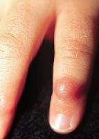 Finger Nodules