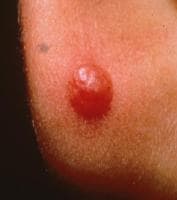 Red Nevus