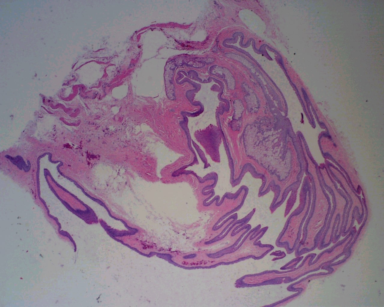 Pathology Outlines Steatocystoma