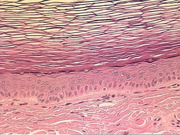 retention cysts or sebaceous cysts. epidermal sebaceous cyst