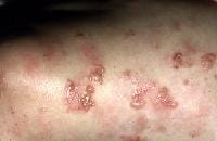 Dermatitis Herpetiformis