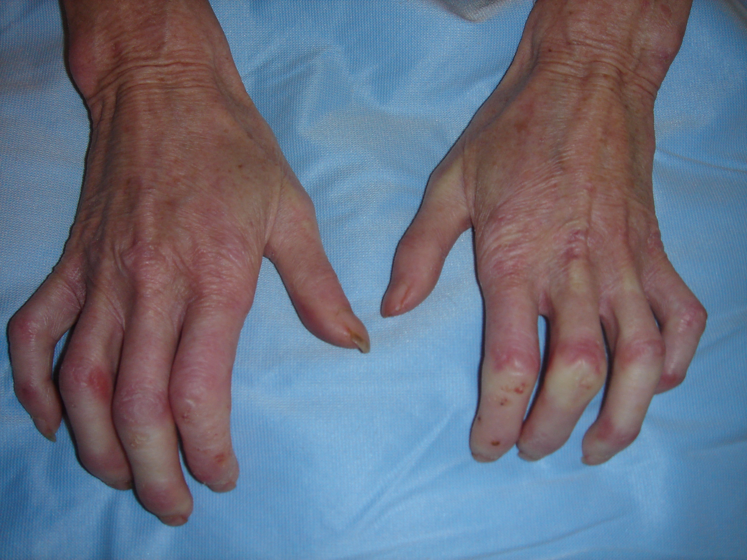 Crest Syndrome; CRST Syndrome