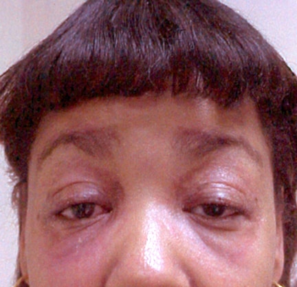 Heliotrope rash in a woman with dermatomyositis.