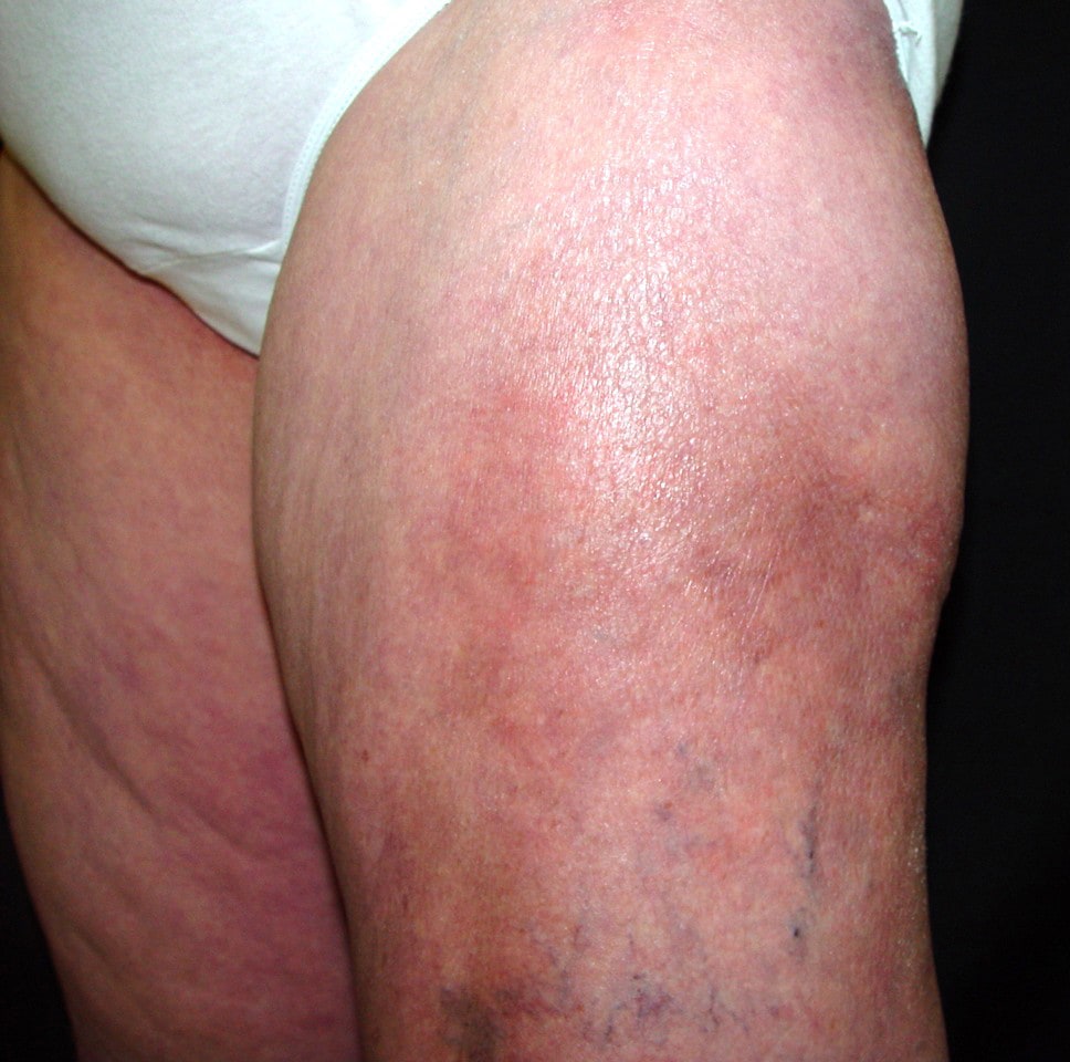 Calcifying panniculitis in a patient with dermato...