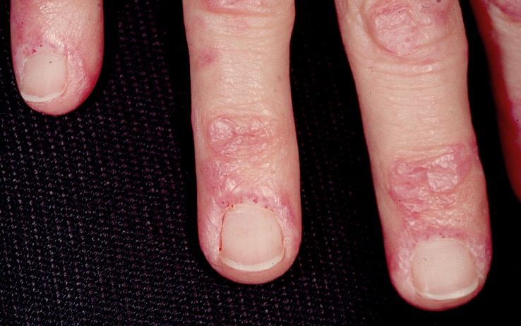 Gottron papules and nail fold telangiectasia are ...