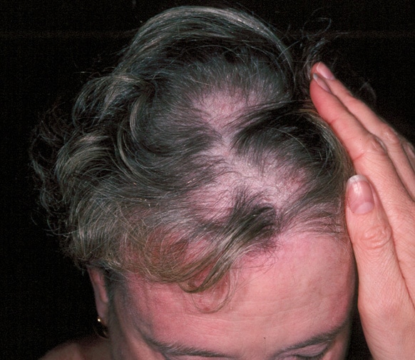 A diffuse alopecia with a scaly scalp dermatosis ...