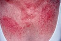 Dermatomyositis is often associated with a poikil...