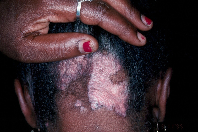 Cicatrical Alopecia on Scarring Alopecia Of Discoid Lupus Erythematosus