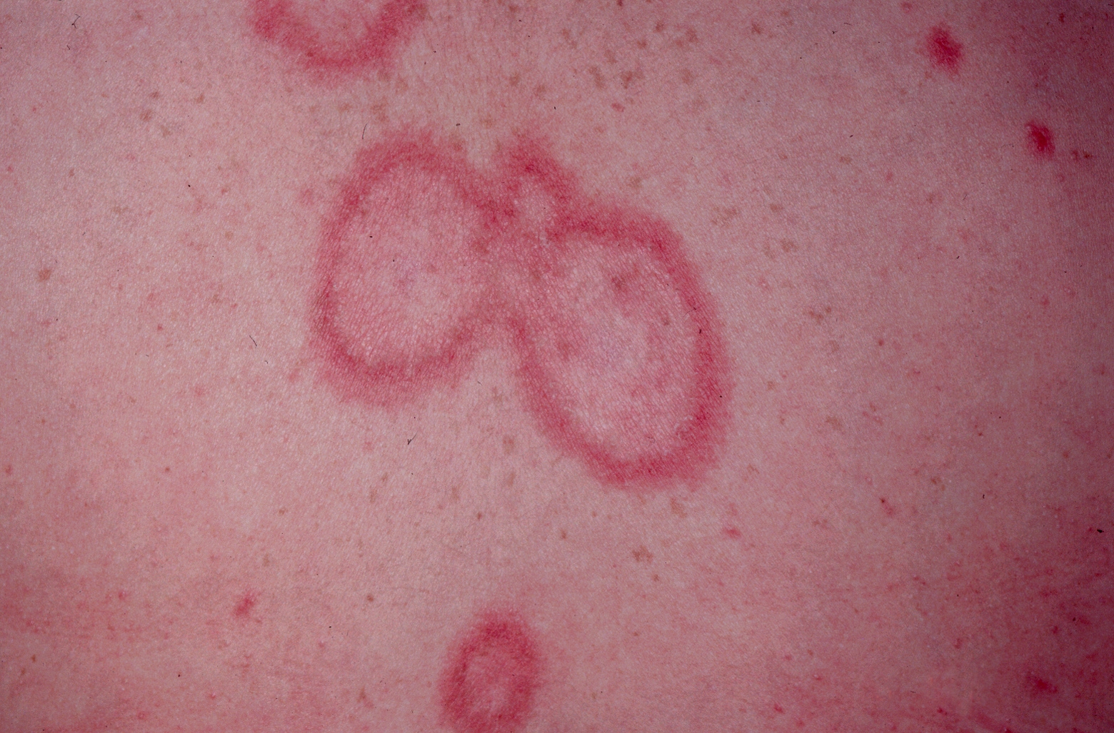 acute cutaneous lupus