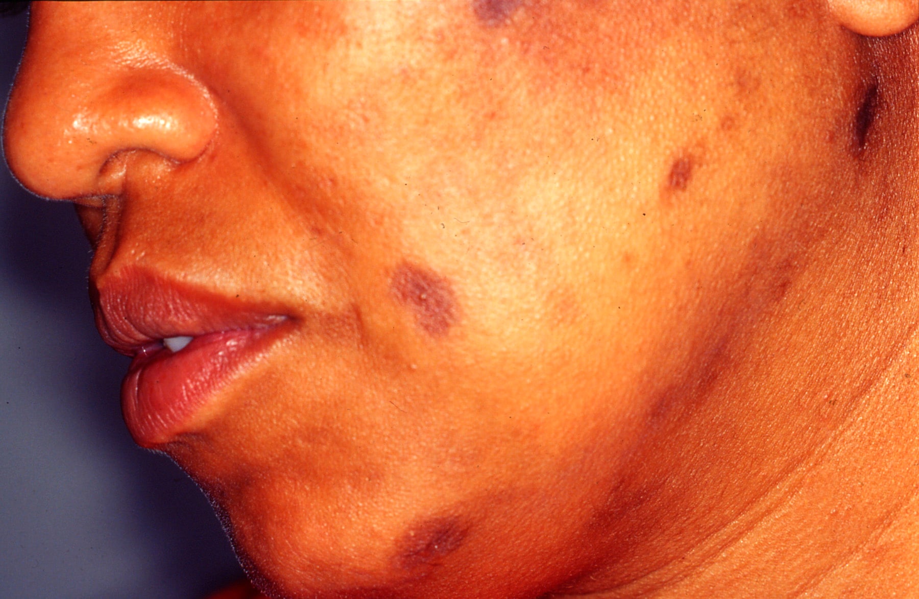 pathology-outlines-hyperpigmentation