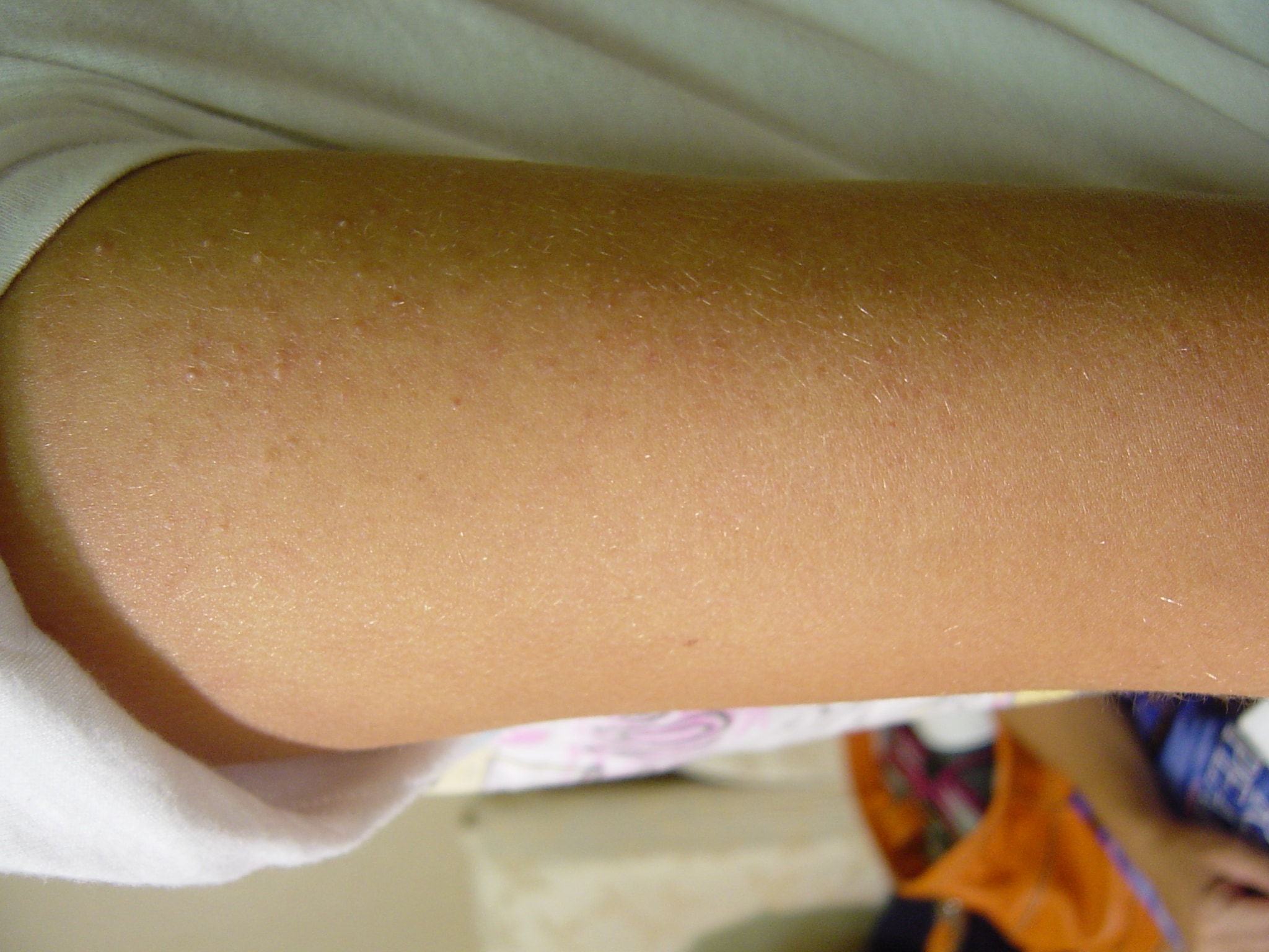 Upper Arm Bumps - Dermatology - MedHelp