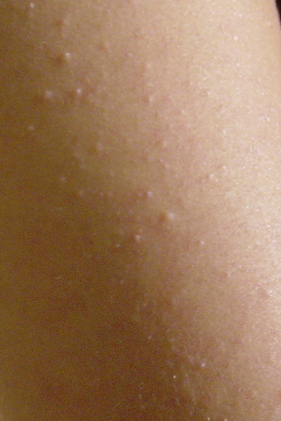 Dermnet: Dermatology Pictures - Skin Disease Pictures