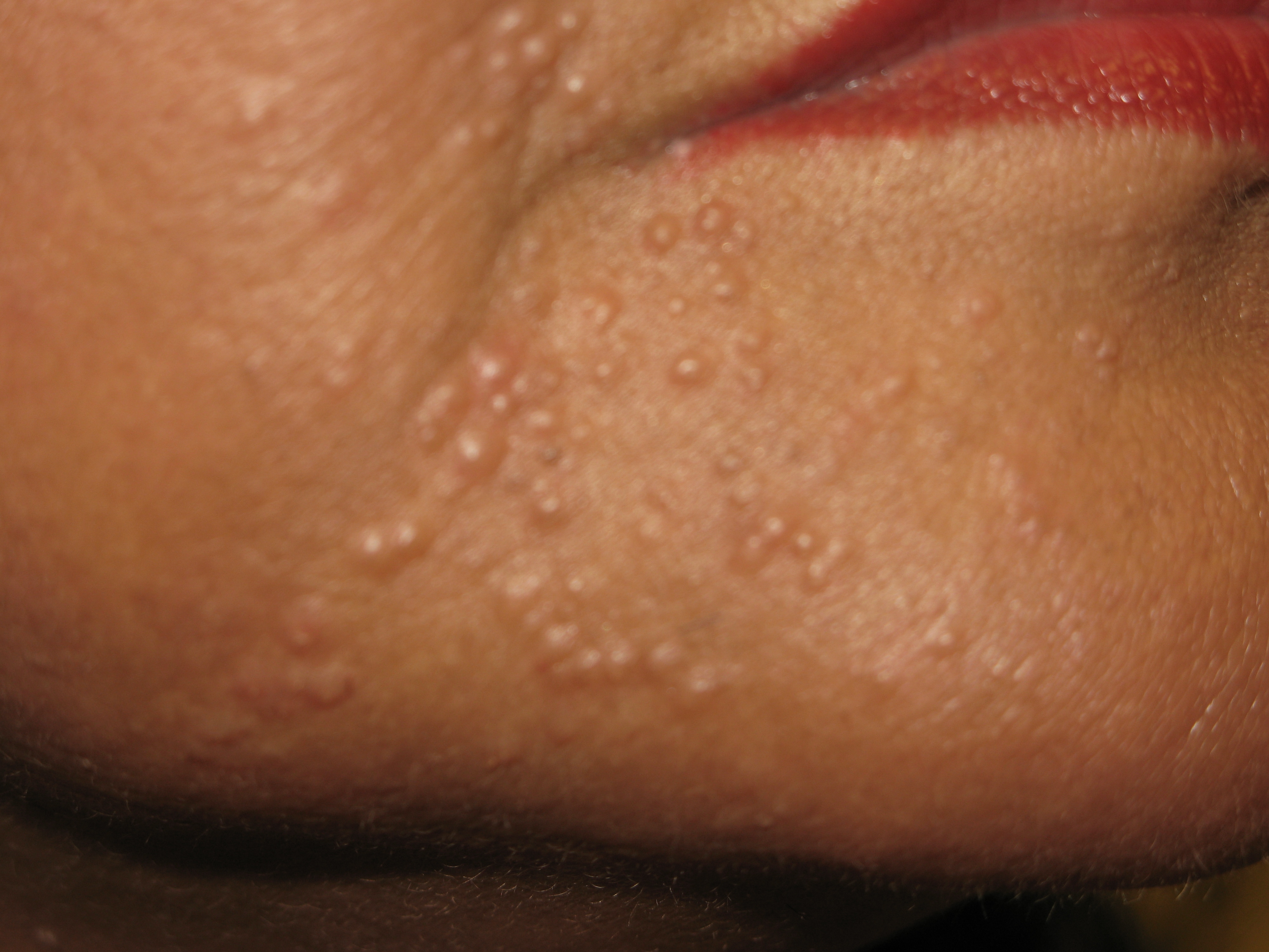 Oil acne - Wikipedia