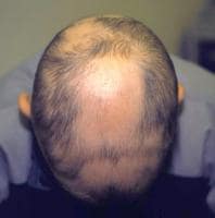 beard alopecia