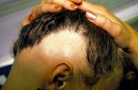 Alopecia Areata Clinical Presentation