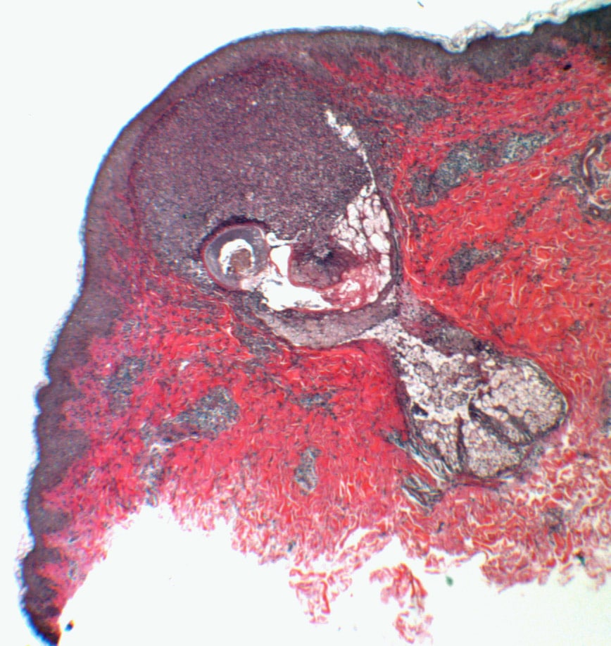 Acute Folliculitis